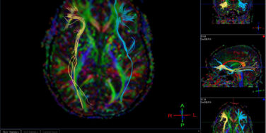 Inside the Dyslexic Brain: